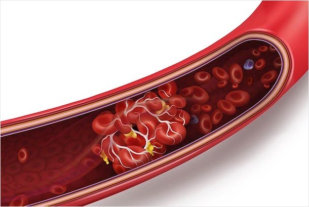 An illustration of a blood clot blocking a vein