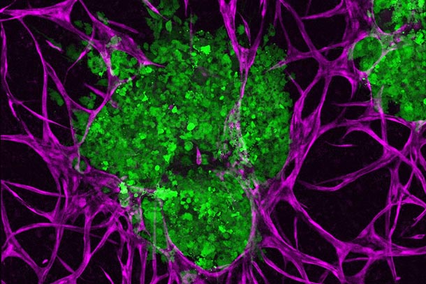 A green tumor is nestled in an interlocking purple branching network