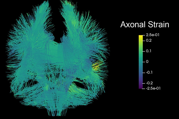 3D image of brain injury damage