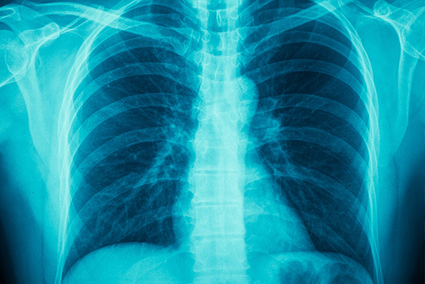 An X-ray of a chest.  